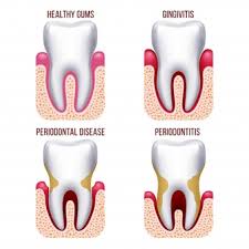 Dental Pro 7 bleeding gums