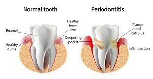 Periodontitis