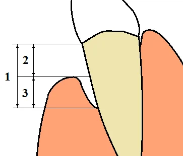 Bleeding gums oral health
