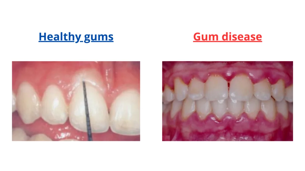 Dental Pro 7 Receding Gums