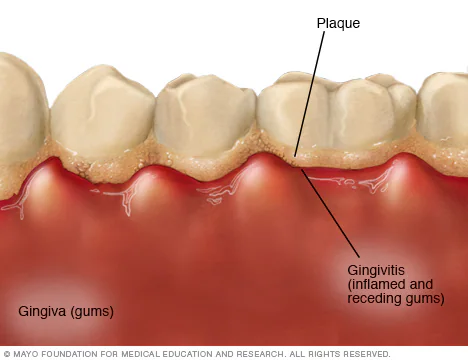 Gum infections and gingivitis Causes